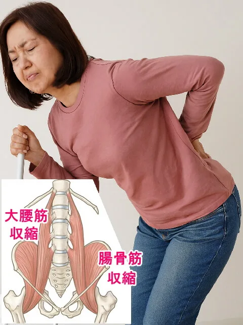 大腰筋、腸骨筋のバランス、収縮が原因でもある